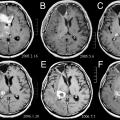 Brain Tumour Classificaion