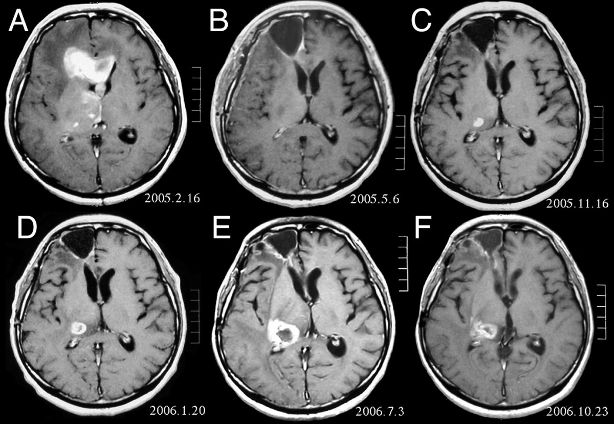 Featured image of post Brain Tumour Classification