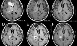 Featured image of post Brain Tumour Classification